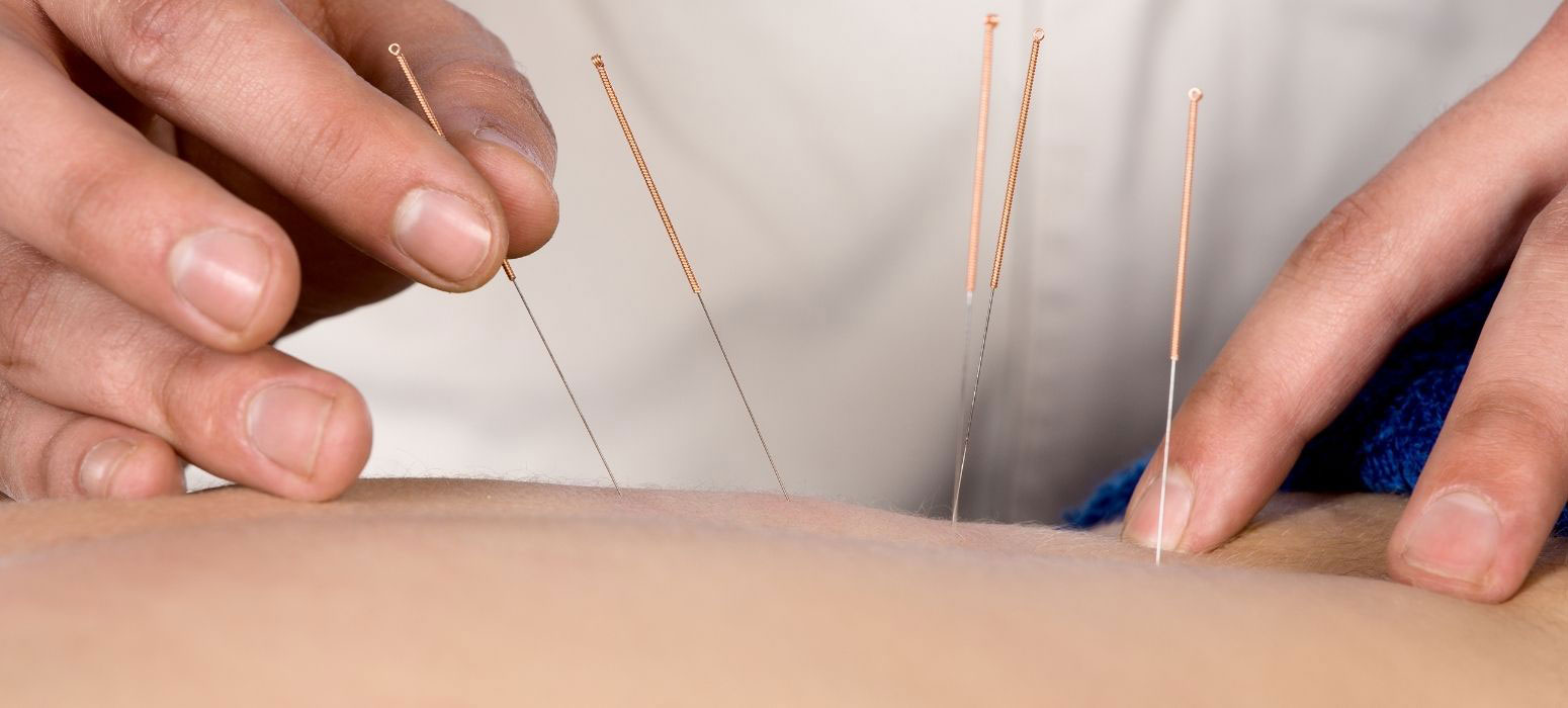 Acupuncture performed on patient